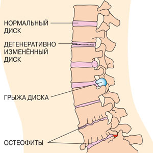 От «оз» до «ит»: как помочь позвоночнику
